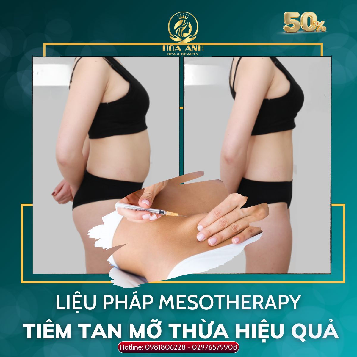 LIỆU PHÁP MESOTHERAPY TIÊM TAN MỠ THỪA